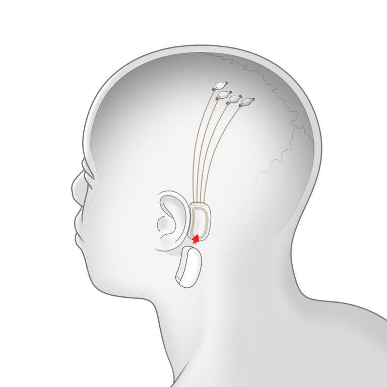 Neuralink-elon musk brain reading